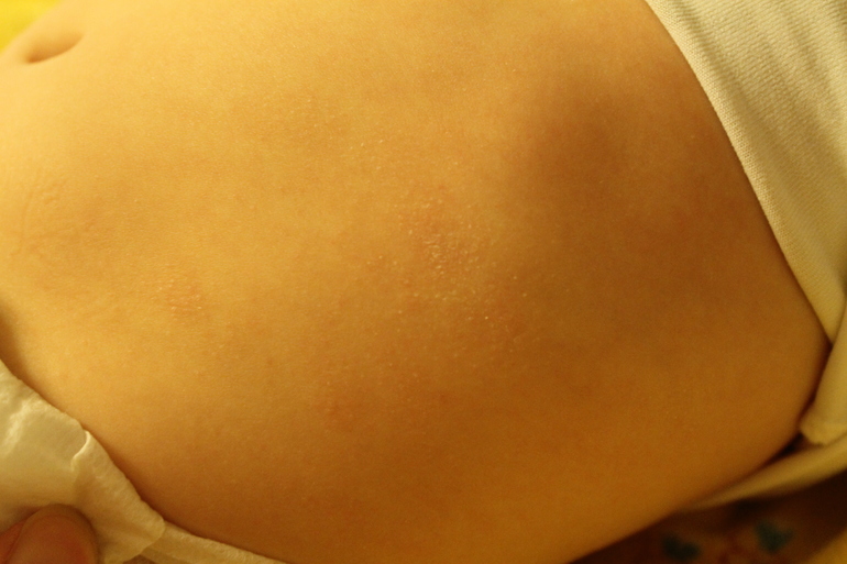Есть ли аллергия на гречку. Аллергическая сыпь на животике. Аллергические пятна на животе у грудничка. Аллергия у ребенка на прикорм. Аллергические высыпания на коже у ребенка.