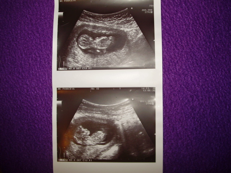 12 недель и 1 день. УЗИ первый скрининг 12 недель. УЗИ на 12 неделе беременности скрининг. Скрининг 12-13 недель беременности. Фото 1 скрининга УЗИ 12 недель беременности.