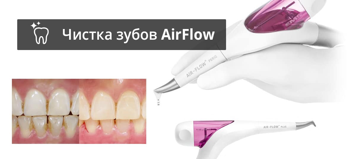 Airflow style pro. Air Flow АИР флоу. Отбеливание эмали зубов методом «Air-Flow». Отбеливание Air-Flow до и после.