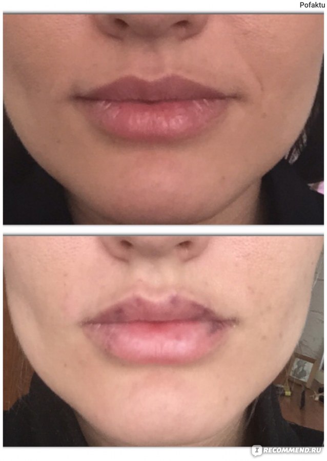 Увеличение губ как заживает. J Ultra 3 гиалуроновая кислота губы. Зажившие губы после гиалуроновой кислоты 1 мл. Губы после гиалуроновой кислоты 1 мл.